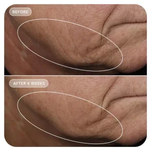 pdp_volulift_beforeandafter_model_1